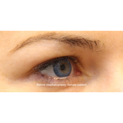 Blepharoplasty Before & After Patient #15009