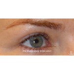 Blepharoplasty Before & After Patient #15009
