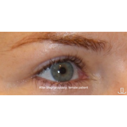 Blepharoplasty Before & After Patient #15009