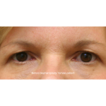 Blepharoplasty Before & After Patient #15008