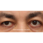 Blepharoplasty Before & After Patient #13441