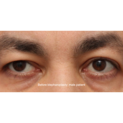 Blepharoplasty Before & After Patient #13441