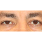Blepharoplasty Before & After Patient #13441