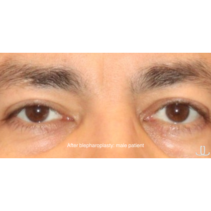 Blepharoplasty Before & After Patient #13441