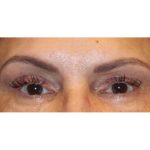 Otoplasty Before & After Patient #13918