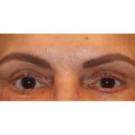 Otoplasty Before & After Patient #13918