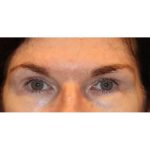 Otoplasty Before & After Patient #13916
