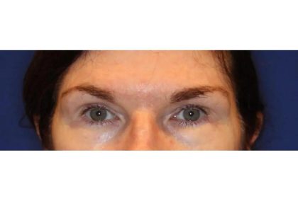 Otoplasty Before & After Patient #13916