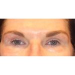 Otoplasty Before & After Patient #13916