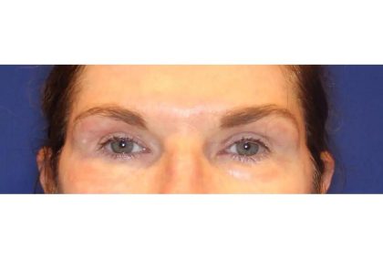 Otoplasty Before & After Patient #13916