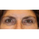 Otoplasty Before & After Patient #13917
