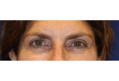 Otoplasty Before & After Patient #13917