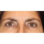 Otoplasty Before & After Patient #13917