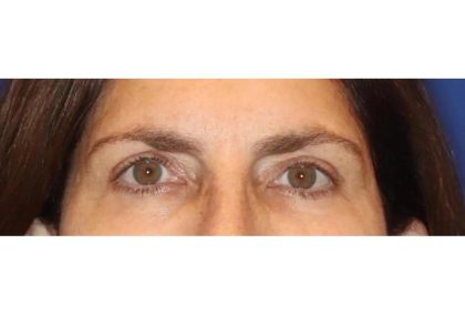 Otoplasty Before & After Patient #13917