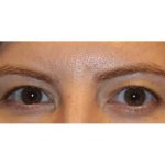 Blepharoplasty Before & After Patient #13439