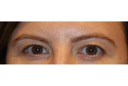 Blepharoplasty Before & After Patient #13439