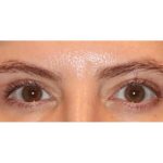 Blepharoplasty Before & After Patient #13439