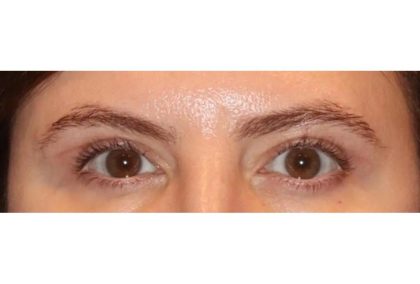 Blepharoplasty Before & After Patient #13439