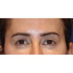 Otoplasty Before & After Patient #13915