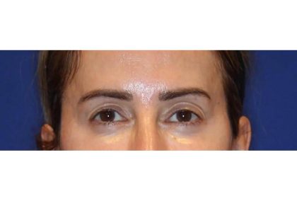 Otoplasty Before & After Patient #13915