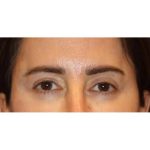 Otoplasty Before & After Patient #13915