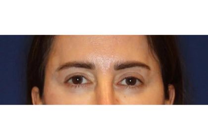 Otoplasty Before & After Patient #13915