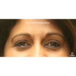 Brow Lift Before & After Patient #15807