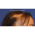 Hair Restoration Before & After Patient #15833