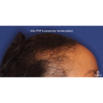 Hair Restoration Before & After Patient #15833