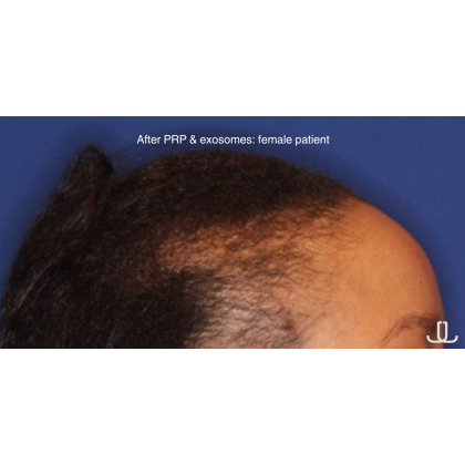Hair Restoration Before & After Patient #15833