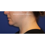 Neck Liposuction Before & After Patient #15837