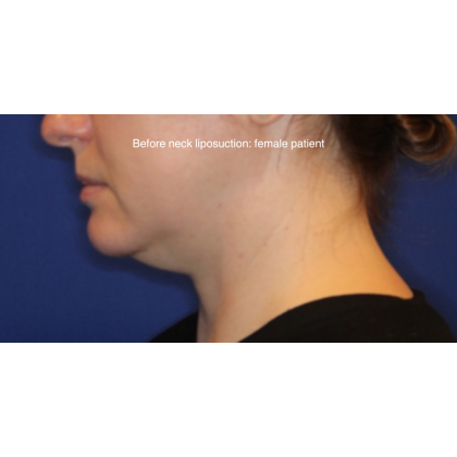 Neck Liposuction Before & After Patient #15837