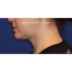Neck Liposuction Before & After Patient #15837