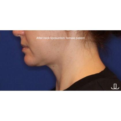Neck Liposuction Before & After Patient #15837