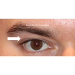 Botox & Wrinkle Relaxers Before & After Patient #15143