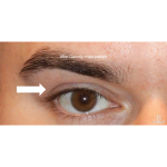 Botox & Wrinkle Relaxers Before & After Patient #15143