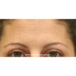Botox & Wrinkle Relaxers Before & After Patient #15134