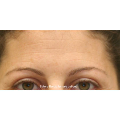 Botox & Wrinkle Relaxers Before & After Patient #15134