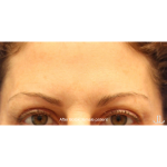 Botox & Wrinkle Relaxers Before & After Patient #15134