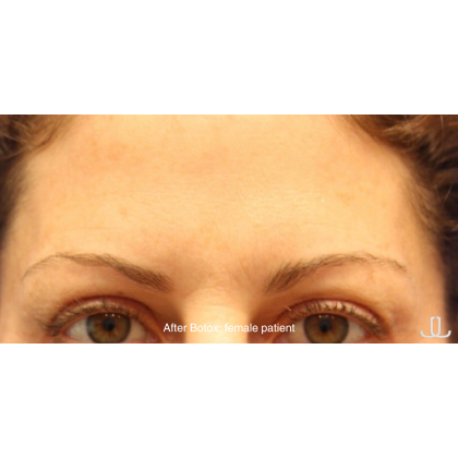 Botox & Wrinkle Relaxers Before & After Patient #15134