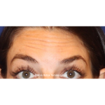 Botox & Wrinkle Relaxers Before & After Patient #15135
