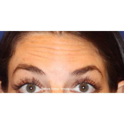 Botox & Wrinkle Relaxers Before & After Patient #15135