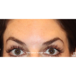 Botox & Wrinkle Relaxers Before & After Patient #15135