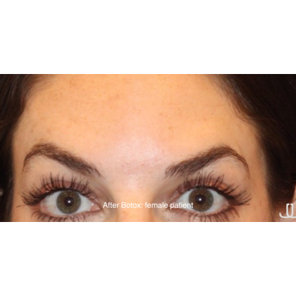 Botox & Wrinkle Relaxers Before & After Patient #15135