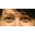 Botox & Wrinkle Relaxers Before & After Patient #15137