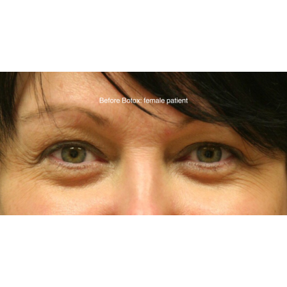 Botox & Wrinkle Relaxers Before & After Patient #15137