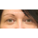 Botox & Wrinkle Relaxers Before & After Patient #15137