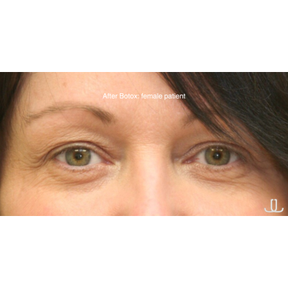 Botox & Wrinkle Relaxers Before & After Patient #15137