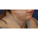 Ultherapy Before & After Patient #13329