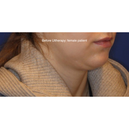 Ultherapy Before & After Patient #13329